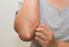 Itchy skin: an early warning sign of kidney disease