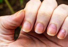 Pale lips and brittle nails: visible signs that may reveal a hidden health issue