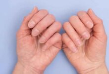 Changes in Nail Shape: A Possible Early Sign of Heart Failure