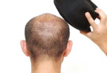 Do Hats Cause Hair Loss? Experts Clarify the Truth