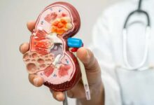 Do high summer temperatures increase the risk of kidney stones?