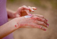 Study: psychological stress worsens eczema