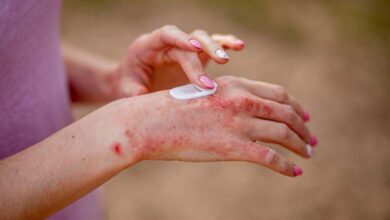Study: psychological stress worsens eczema