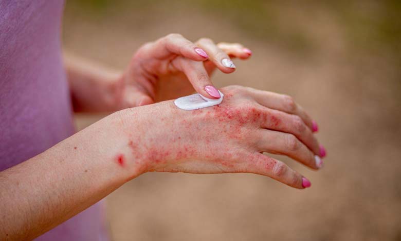 Study: psychological stress worsens eczema