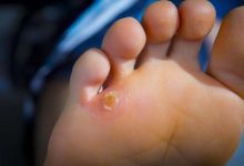 As summer approaches, how can you get rid of foot calluses and prevent their recurrence?