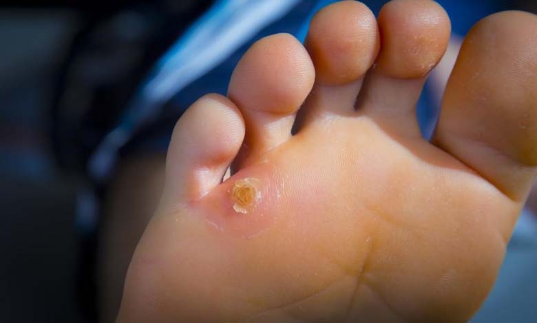 As summer approaches, how can you get rid of foot calluses and prevent their recurrence?