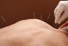 Acupuncture as a safer alternative: its role in addressing the opioid crisis