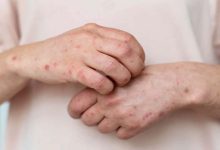 Simple daily habits to reduce eczema symptoms during summer