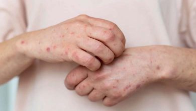 Simple daily habits to reduce eczema symptoms during summer