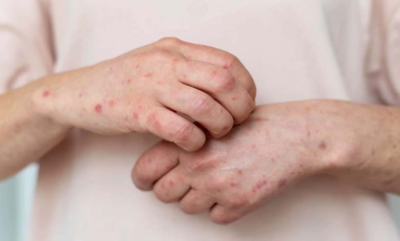 Simple daily habits to reduce eczema symptoms during summer