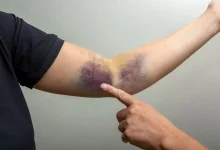 Can Skin Discoloration After Air Travel Signal a Dangerous Blood Clot?