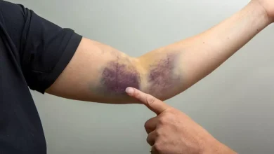 Can Skin Discoloration After Air Travel Signal a Dangerous Blood Clot?