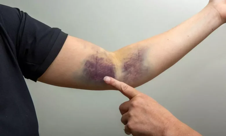 Can Skin Discoloration After Air Travel Signal a Dangerous Blood Clot?