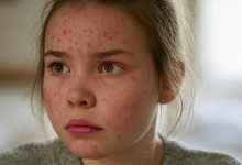 Measles Triggers Concern Following Rising Cases in the United States
