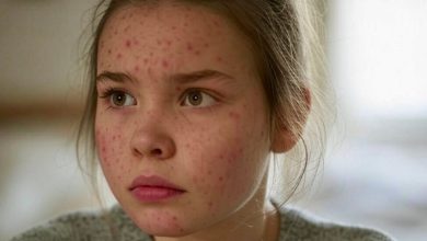 Measles Triggers Concern Following Rising Cases in the United States