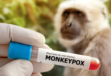 Pakistan confirms a new monkeypox case in Karachi amid renewed public health vigilance