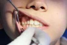 Intermittent Fasting May Help Treat Gum Disease