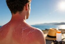 Alarming Study: Can a Single Sunburn Contribute to Cancer?