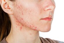 Do Sugary Foods Make Acne Worse? Here’s What the Evidence Really Shows