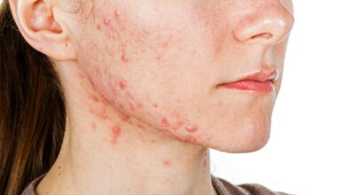 Do Sugary Foods Make Acne Worse? Here’s What the Evidence Really Shows