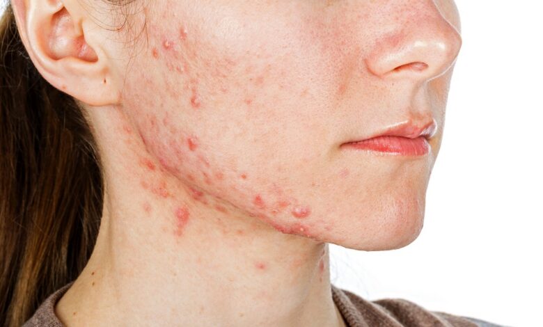 Do Sugary Foods Make Acne Worse? Here’s What the Evidence Really Shows