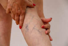 Varicose Veins: Everyday Habits That Help Protect Leg Health
