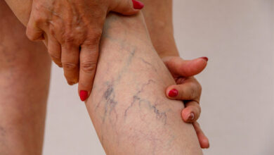 Varicose Veins: Everyday Habits That Help Protect Leg Health