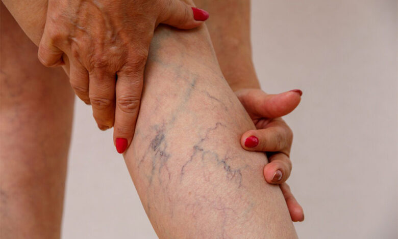 Varicose Veins: Everyday Habits That Help Protect Leg Health